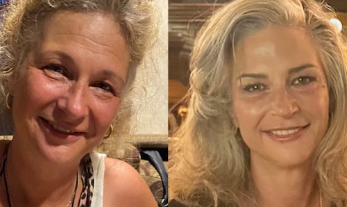 PLLA Thread Lift Before After Mississauga Oakville